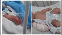 Bebê internado por problema respiratória ganha braço inchado na Santa Casa