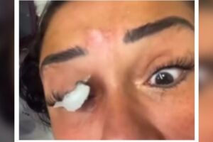 Esteticista usa cola Super Bonder em extensão de cílios e empresária quase fica cega (vídeo)