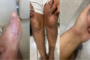 Marcas de hematomas ficaram pelo corpo da vítima