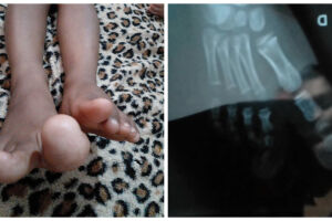 Menina de apenas 3 anos sofre com o crescimento contínuo dos dedos