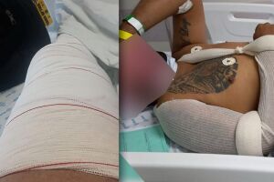 Jovem sofreu fratura no joelho e passou por cirurgia