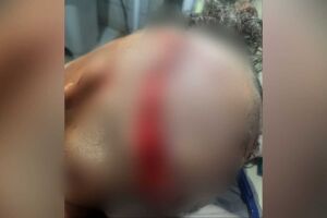 Ataque de cachorro quase mata criança em Dourados