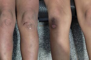 Marcas das tampinhas nos joelhos das vítimas
