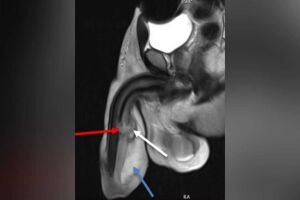 Paciente foi diagnosticado com uma "fratura peniana tripla