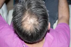 Cl&iacute;nica procura volunt&aacute;rios para pesquisa sobre calv&iacute;cie 