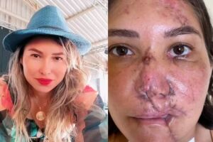 Após acidente de moto, mulher faz 4 cirurgias para reconstruir a face (vídeo)