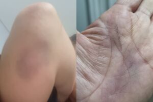 Marcas da última agressão sofrida pela vítima