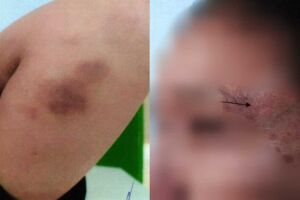 Vítima tinha marcas no rosto e nos braços de agressões cometidas pelo companheiro