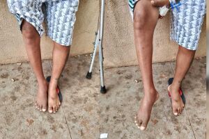 Internado há 5 meses, carpinteiro espera por prótese e cirurgia no fêmur em Campo Grande
