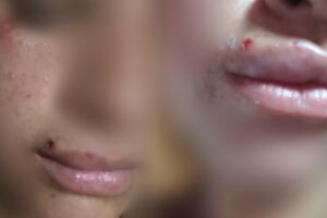 Buraco em rua deixa ciclista e bebê de 1 ano feridos no Caiobá