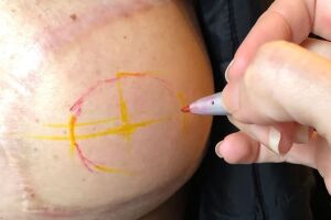 Tatuagem e micropigmenta&ccedil;&atilde;o promovem a transforma&ccedil;&atilde;o de mulheres mastectomizadas