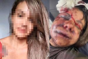 Mulher espancada com 60 socos por ex passará por reconstrução facial