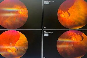 Olho de Flávia com sangramentos que atrapalham a visão