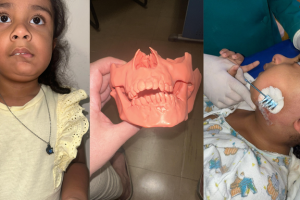 Cirurgia inédita em MS permite criança com deformidade na mandíbula a comer e respirar melhor