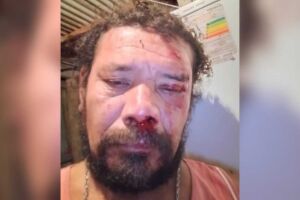 "Estou todo dolorido", diz homem atacado por onça ao tentar defender cachorro em Corumbá