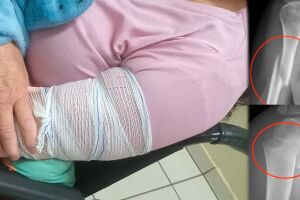 Idosa com braço quebrado em três lugares é liberada de UPA e aguarda vaga na Santa Casa 