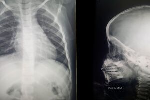 Sem raio-X e pediatra, mãe faz tour em UPAs para conseguir atendimento a filha em Campo Grande