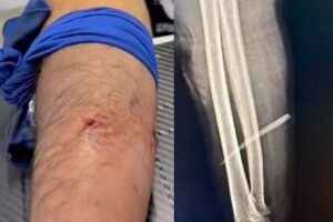 Ele foi ferroado na quarta-feira, durante uma pescaria