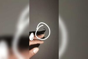 Três meses à espera de cirurgia para retirada de pino, jovem teme infecção: 'já passou da hora'