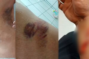 Homem mostra marcas das agressões sofridas pela ex-esposa durante brigas do casal