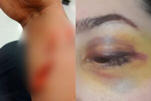 Braço do marido cortado com garrada e o olho da esposa roxo