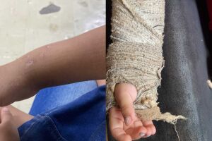 Menina de 3 anos espera mais de 45 dias para retirar pinos do braço após cirurgia na Santa Casa