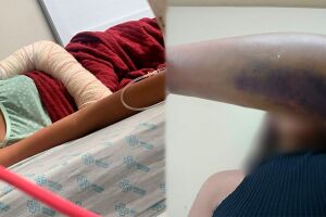 Após agressão na escola, adolescente espera mais de 15 dias por cirurgia em Campo Grande