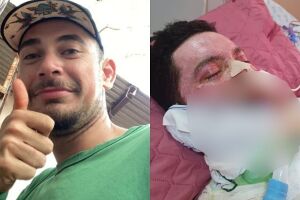 Jovem queimado com chapa espera há 5 meses por exame de broncoscopia em Campo Grande