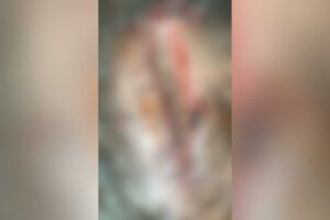 Atacada com machado, mulher sofre com larvas em ferimento aberto e espera vaga na Santa Casa (v&iacute;deo)
