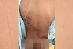 Jovem que teve costas rasgadas por raio em ato de Nikolas: 'Achei que tinha 1h de vida' (v&iacute;deo)