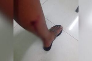 Jovem fica ferida ao ser atacada por cachorro durante caminhada em Ivinhema 