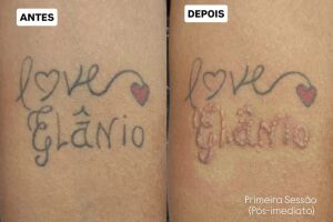 Arrependido? Dia dos Namorados chega com promo&ccedil;&atilde;o inusitada para apagar tatuagem com nome de ex