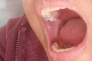 Ch&aacute; de cadeira no dentista: paciente espera h&aacute; 6 meses por consulta no Jardim Tarum&atilde;
