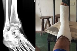 Com dores h&aacute; 4 meses, caseiro espera cirurgia e exp&otilde;e 'limbo' da fila ortop&eacute;dica em Campo Grande
