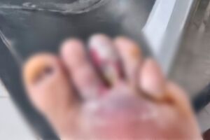 Com tend&atilde;o e osso expostos, paciente diab&eacute;tico precisa de vaga em hospital de Campo Grande