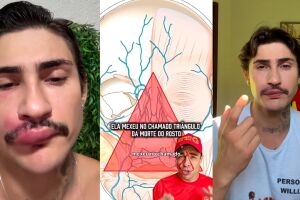 'Ken de CG' sofre infec&ccedil;&atilde;o ao causada por espinha no 'tri&acirc;ngulo da morte' e faz alerta (v&iacute;deo)