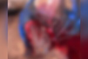 Jovem cai de caminh&atilde;o e tem bra&ccedil;o dilacerado ao ser atropelado em Aquidauana