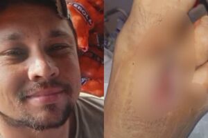 Sem poder trabalhar ap&oacute;s amputa&ccedil;&atilde;o, trabalhador precisa ajuda para pagar aluguel em Campo Grande