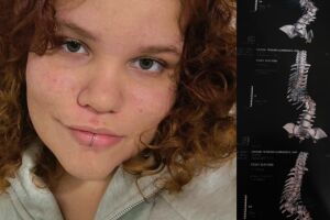 Aos 19 anos, jovem que enfrenta escoliose desde os 3 anos se prepara para nova cirurgia
