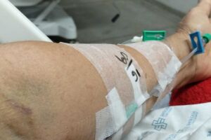 Diab&eacute;tica aguarda por cirurgia na Santa Casa