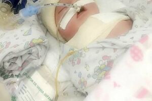 Bebê tem clavícula quebrada ao nascer, fica em estado grave e família acusa erro médico