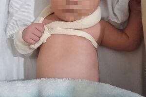 Bebê teve clavícula quebrada e mãe não foi informada