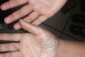 Tortura: Pai queima mãos de crianças como castigo por quebrarem máquina