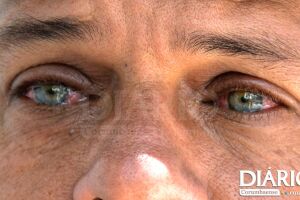 Doença causa irritação profunda nos olhos