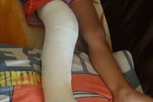 Criança de três anos quebra perna em Ceinf e direção não aciona socorro