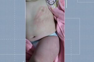 Bebê ficou com marcas de agressão no corpo