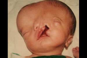 Bebê que nasceu com “2 rostos” completa 14 anos