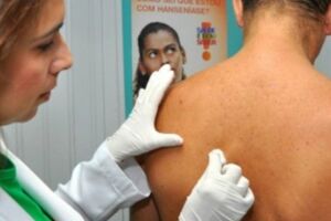 Janeiro Roxo: unidades de saúde promovem ações de prevenção à hanseníase