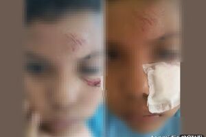 Podia cegar: criança de 8 anos corta o rosto em arame deixado no pátio de escola infantil na Capital