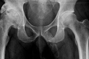 Médicos descobrem que pênis de idoso está se transformando em osso após exame de raio-x